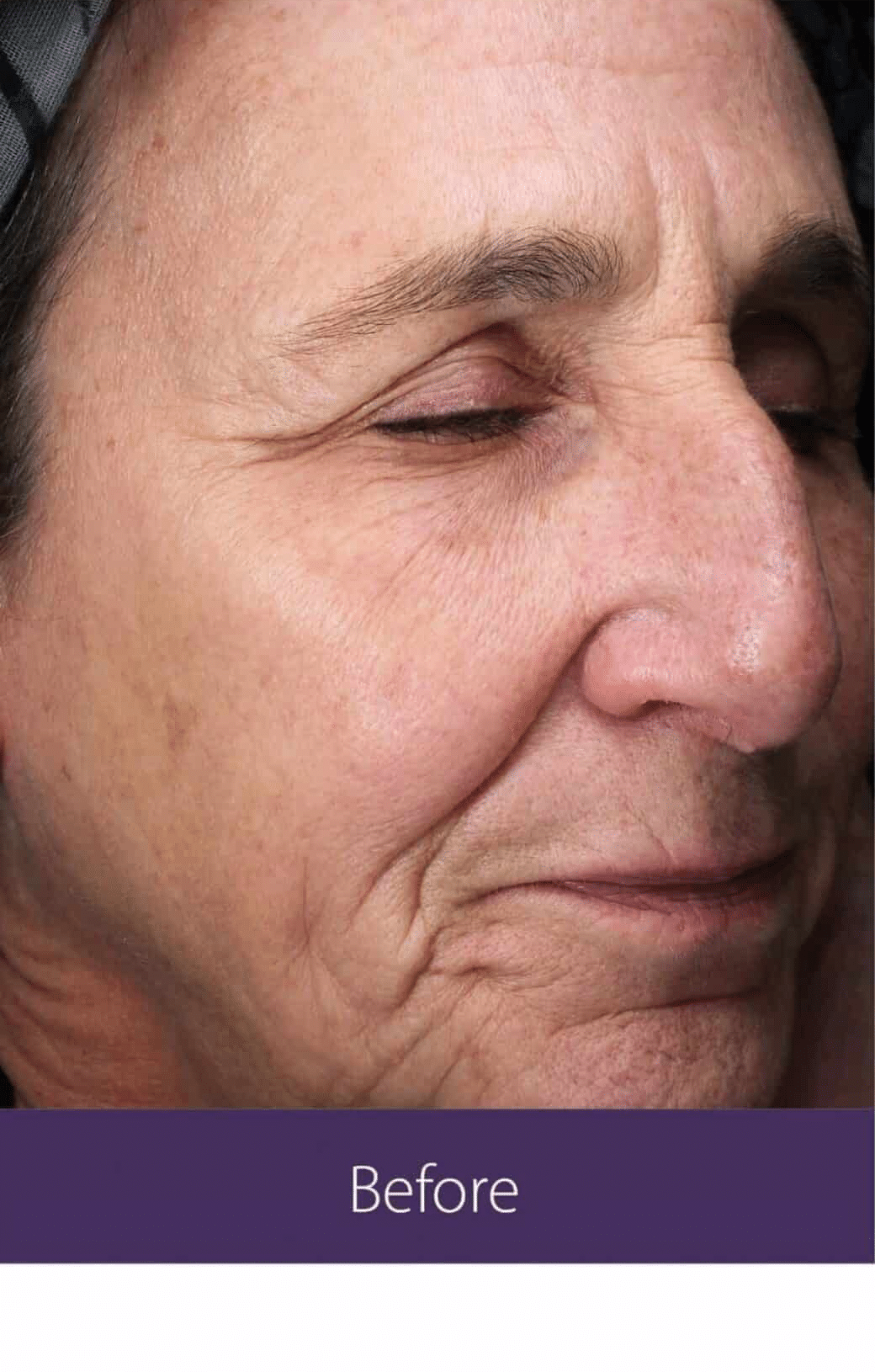 Before Image: Fractional Plasma - right-front-oblique