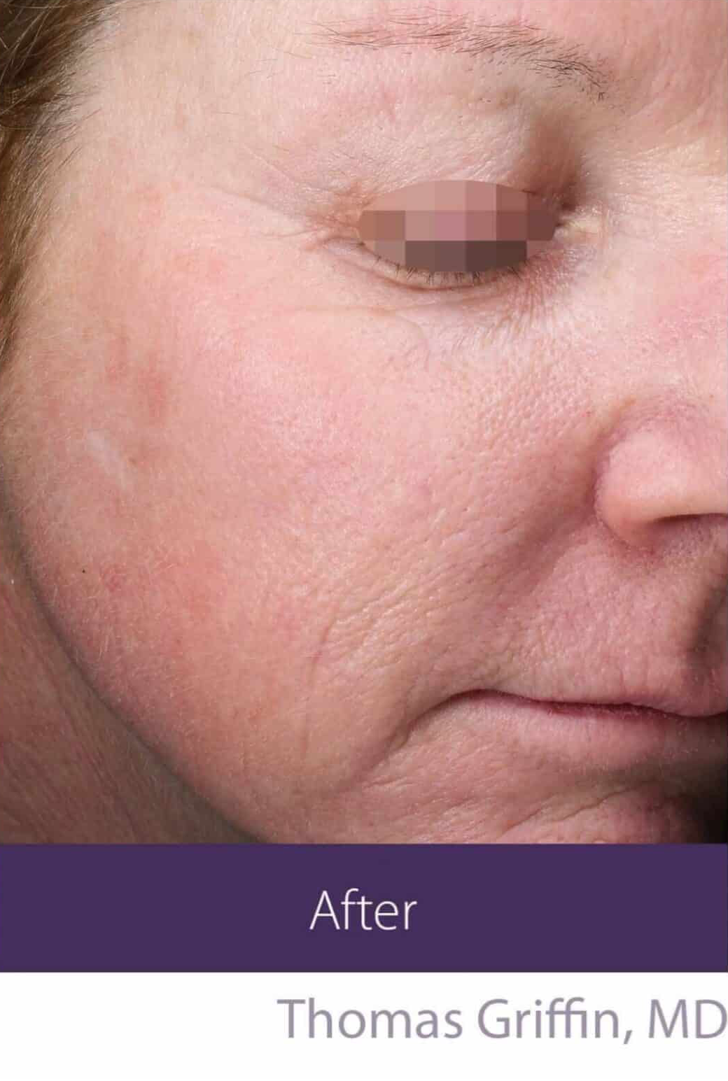 After Image: Fractional Plasma - right-front-oblique