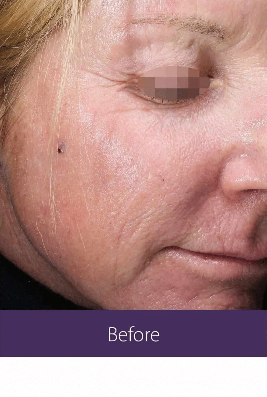 Before Image: Fractional Plasma - right-front-oblique