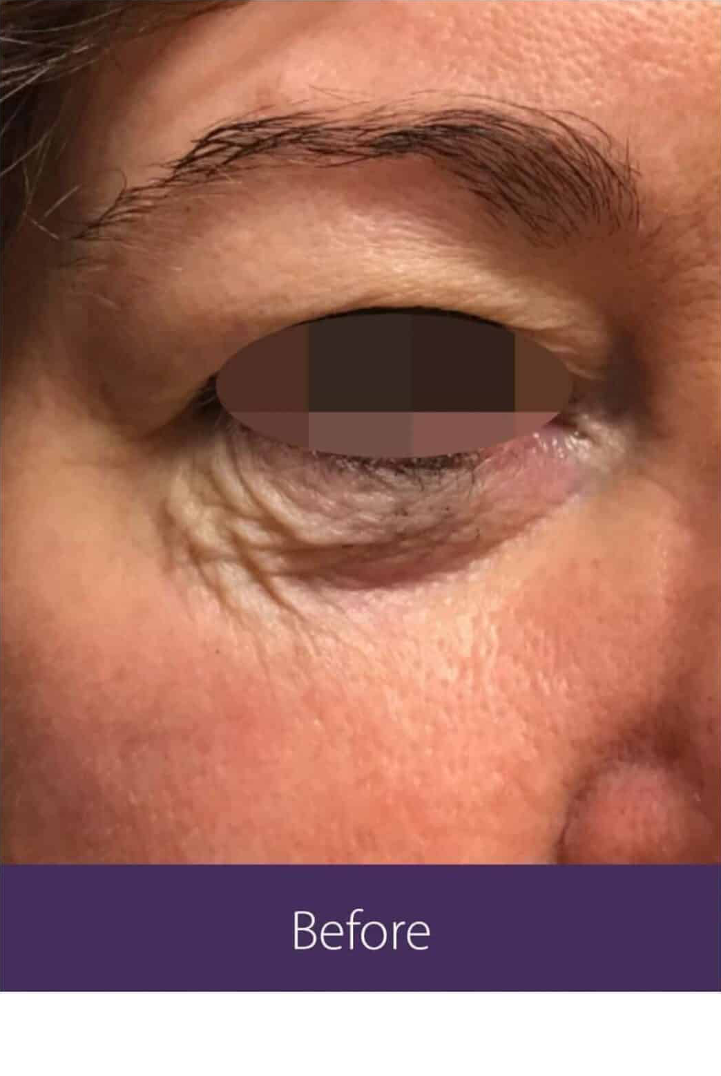 Before Image: Fractional Plasma - right-front-oblique