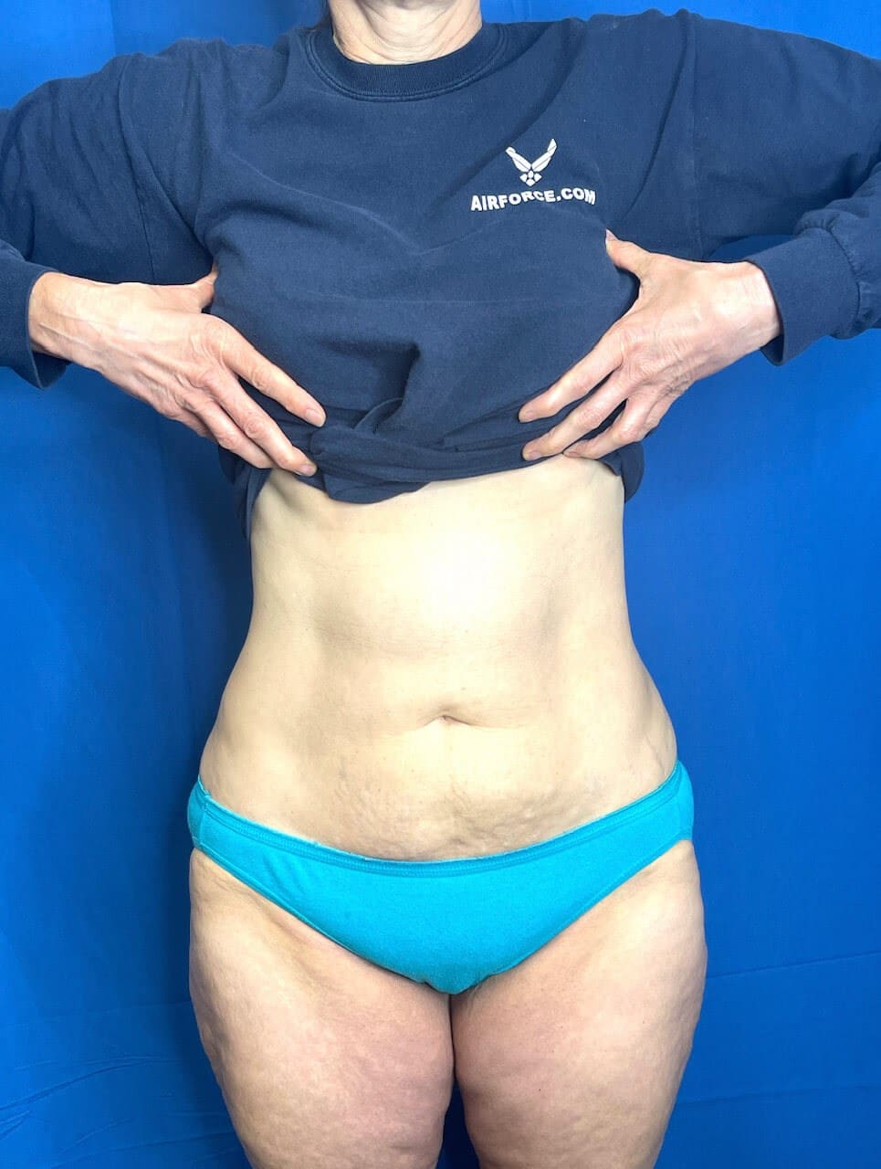 After Image: Abdominal and Hip Sculpting - front