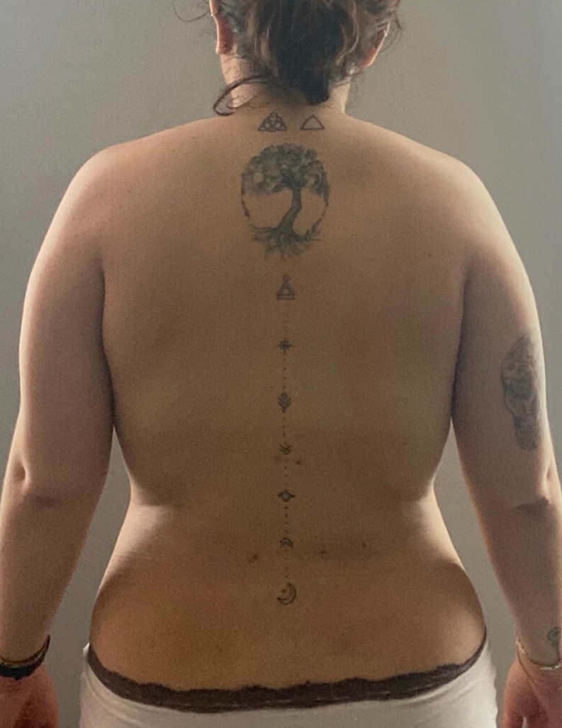 After Image: Bra Line Fat Reduction - back