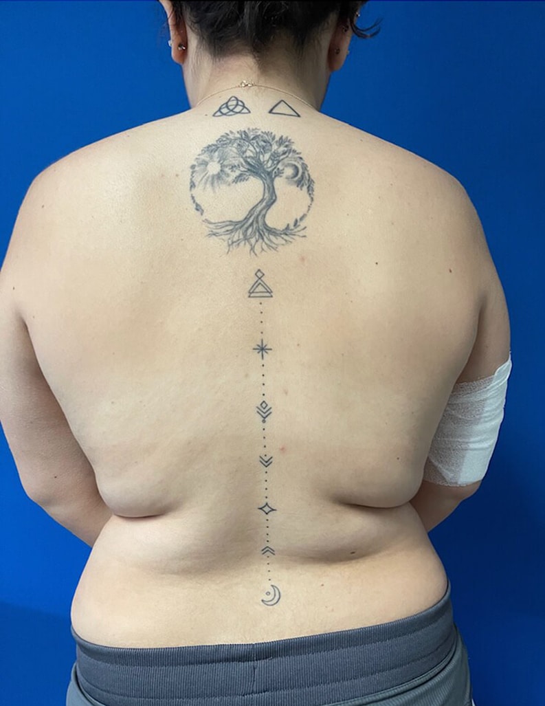 Before Image: Bra Line Fat Reduction - back