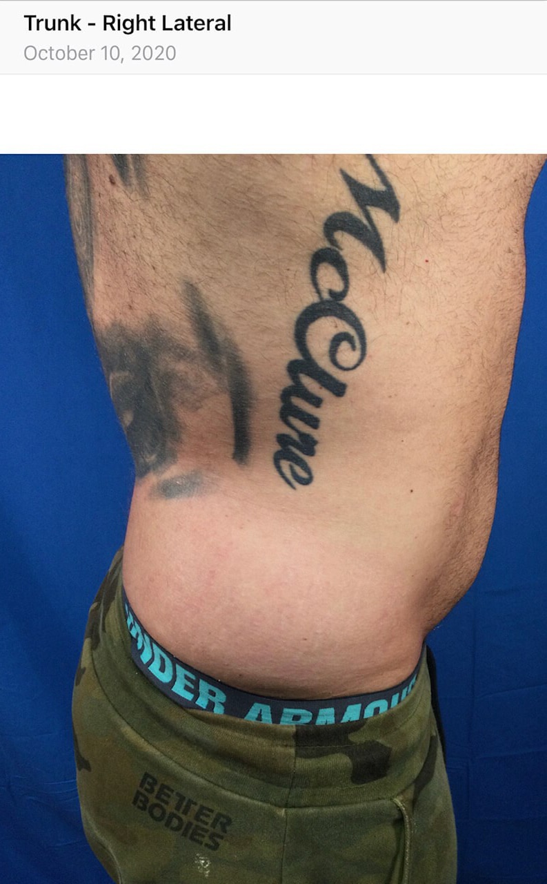 After Image: Stretch Mark Reduction - right-side