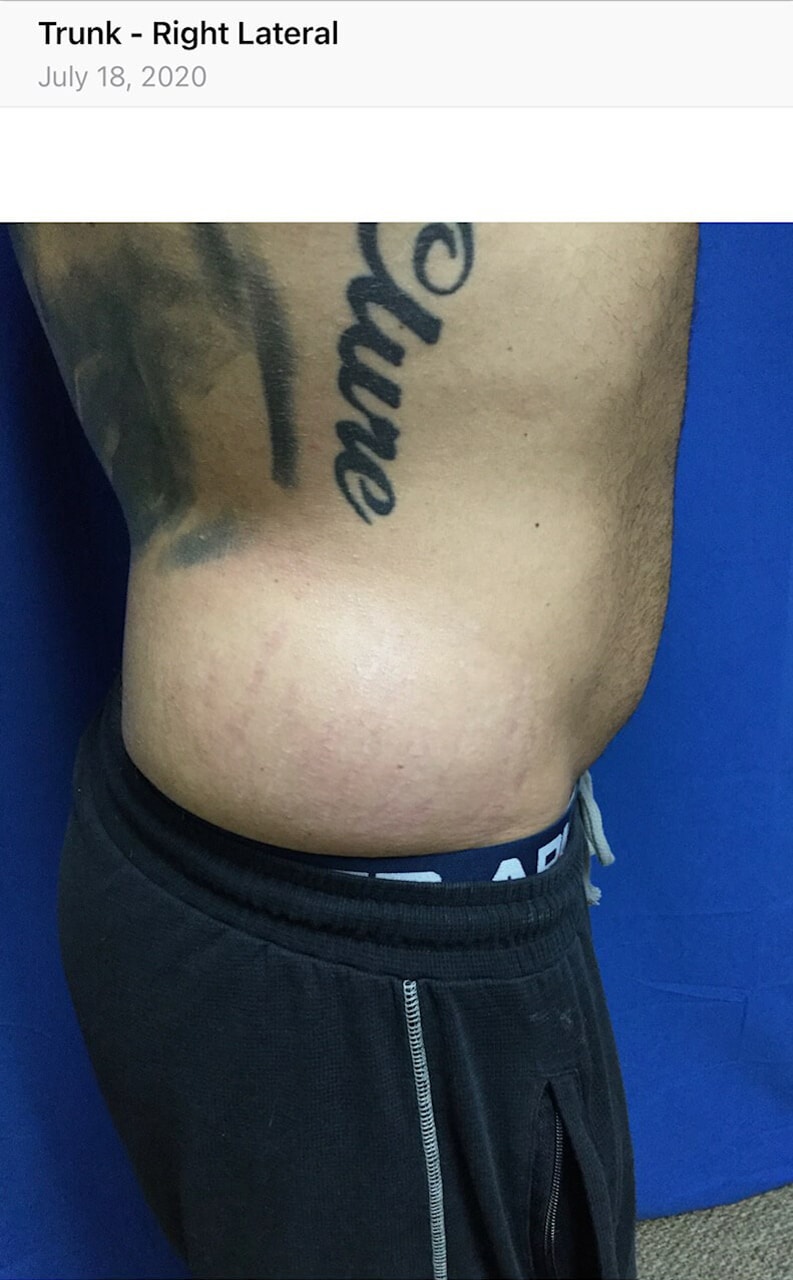 Before Image: Stretch Mark Reduction - right-side